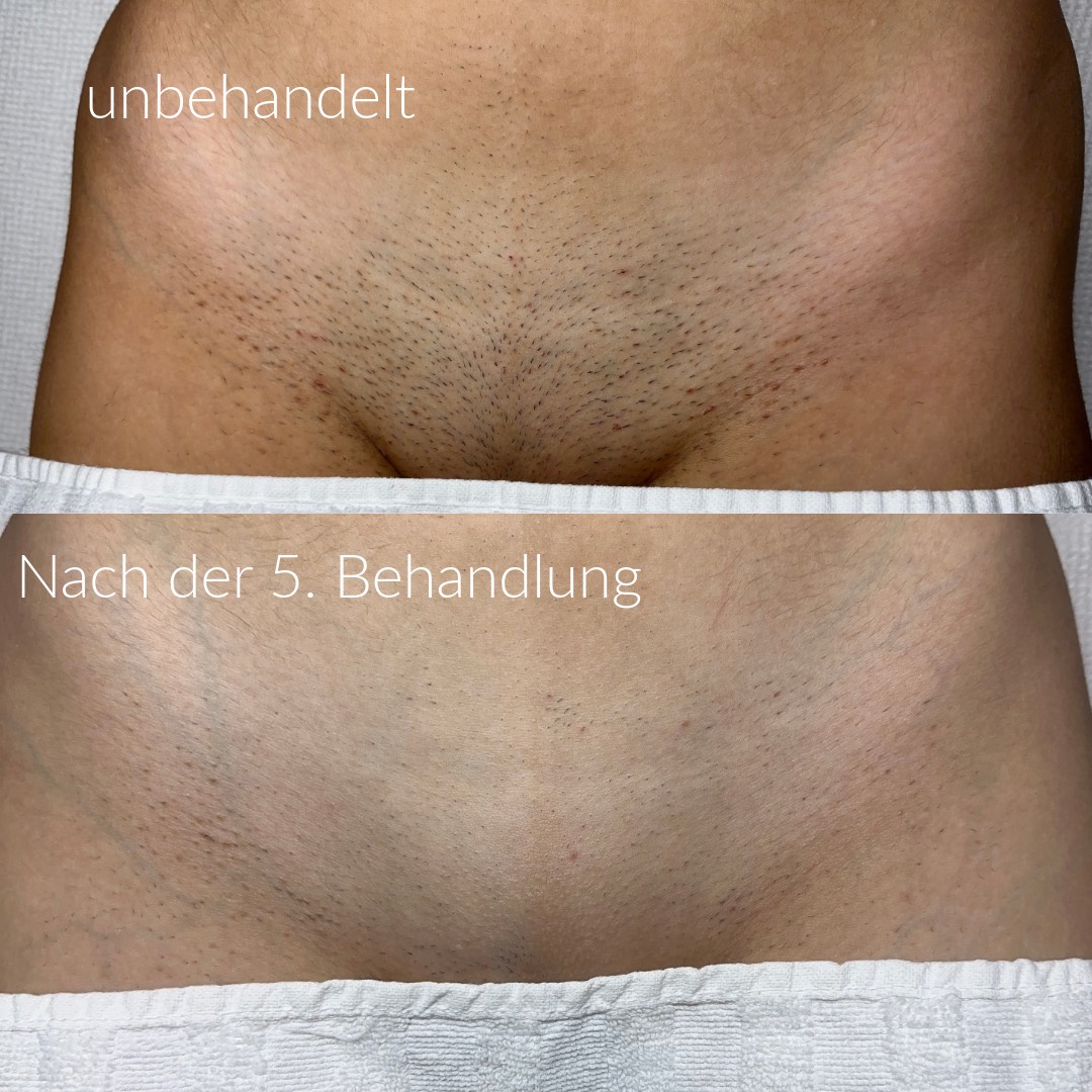 Vorher/Nachher Schambereich Behandlung 1